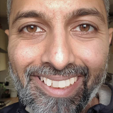 رجل قبل علاج Invisalign®
