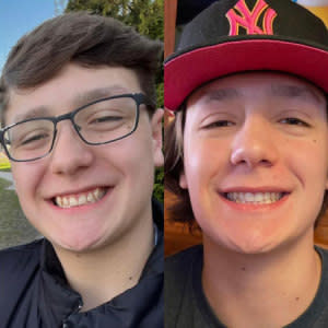 Invisalign® testimonials/reviews from Instagram for all kind of smiles of kids