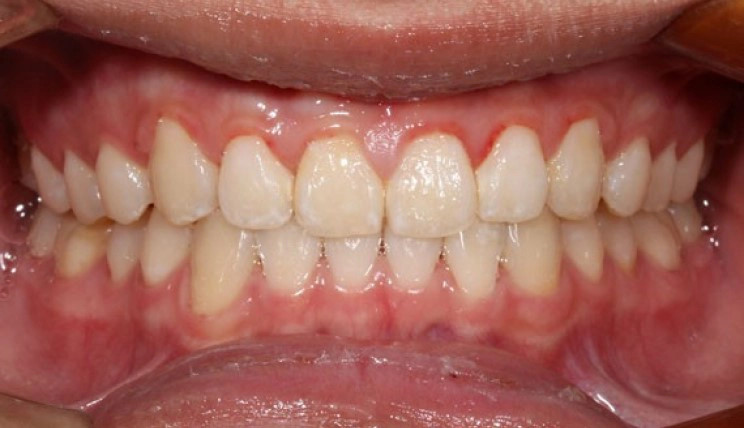 Mandibular advancement case after Invisalign® treatment