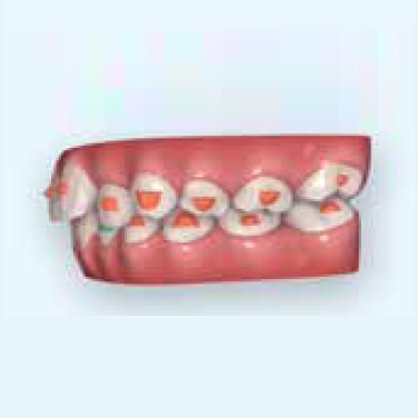 photo-card-invisalign-first-short-clinical-crown-support