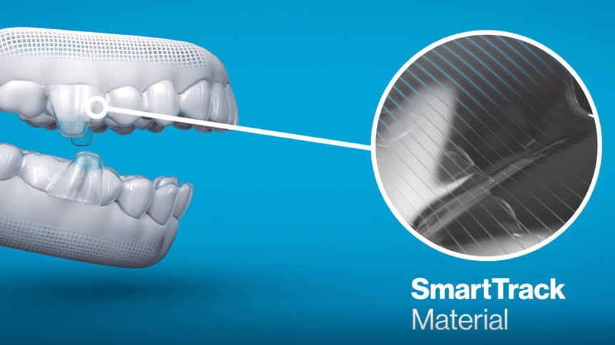 Mandibular Advancement | Invisalign Provider