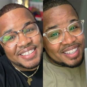 Young man testimonial before and after treatment with transparent aligners