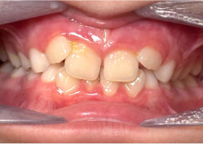 image-card-case2-pre-palatal-expander