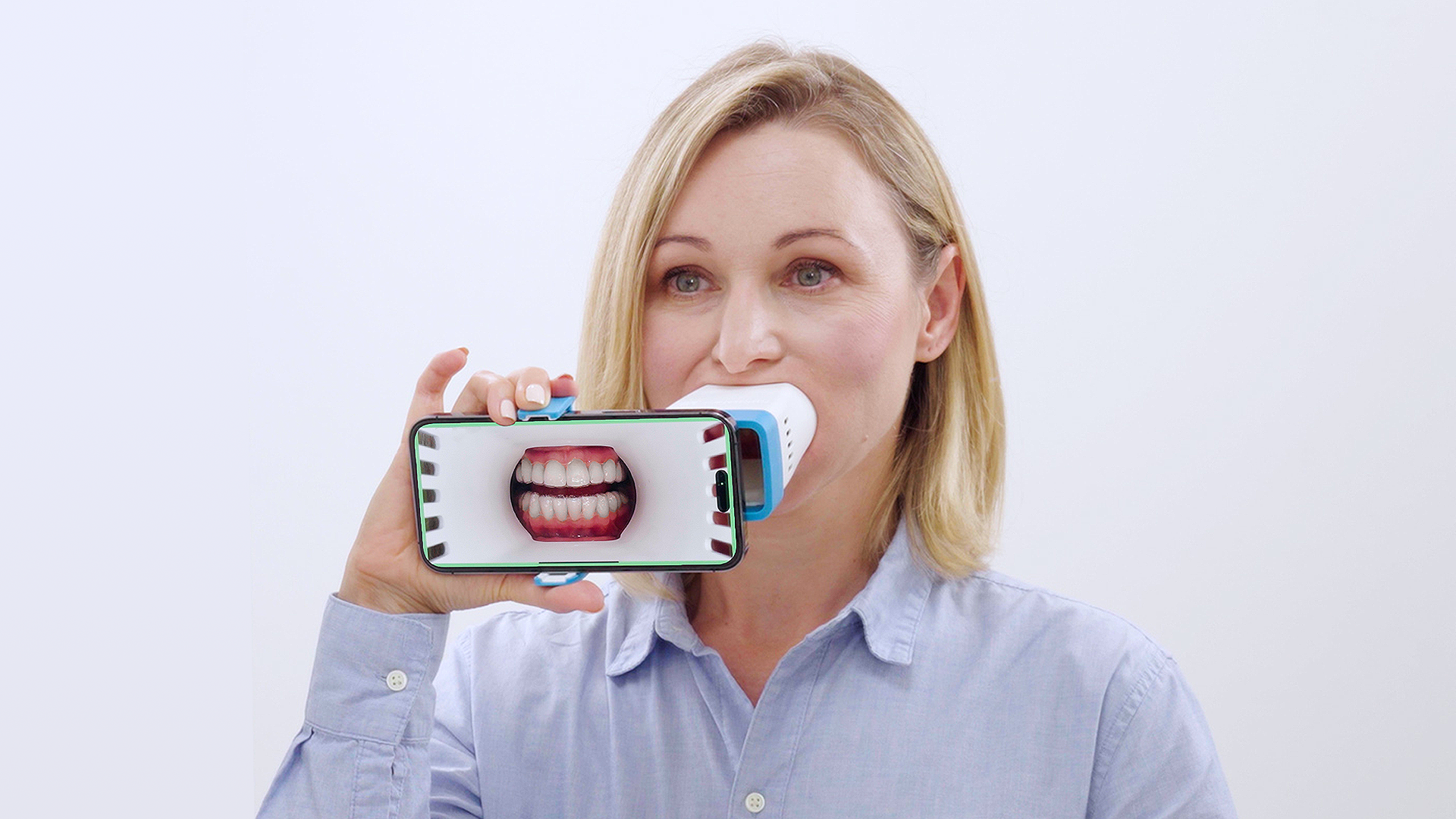 Invisalign Lens Image 2