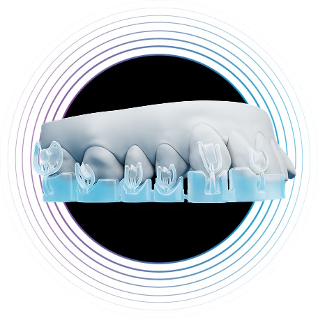 Invisalign Specifix™ Attachment System*  [NEW]