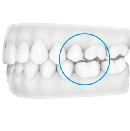 image-text-and-media-g8-posterior-open-bite
