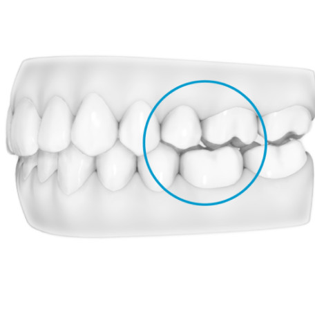 Invisalign G8 sample of how it reduces the likelihood of posterior open bite