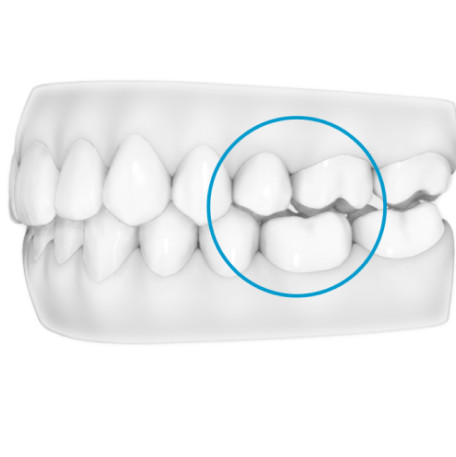image-text-and-media-g8-posterior-open-bite