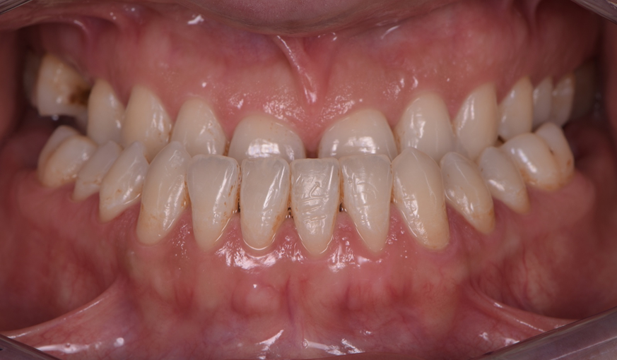 before image