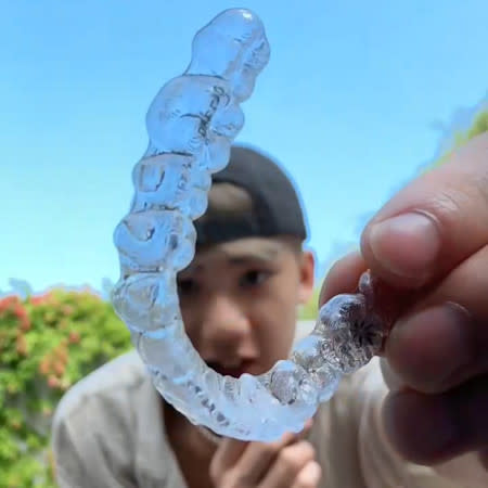 Patientenerfahrungen vor und nach der Invisalign® Behandlung