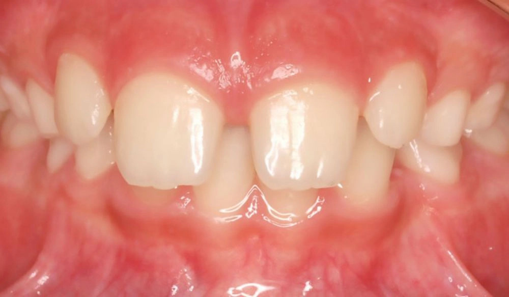 Phase I tooth treatment case before Invisalign® treatment