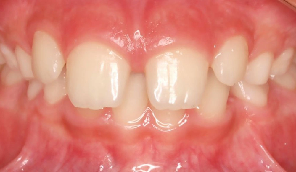 Phase I tooth treatment case before Invisalign® treatment