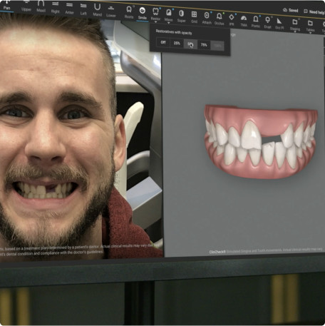 Invisalign Smile Architect software view with patient case