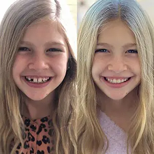 Little girl testimonial before and after treatment with Invisalign® clear aligners