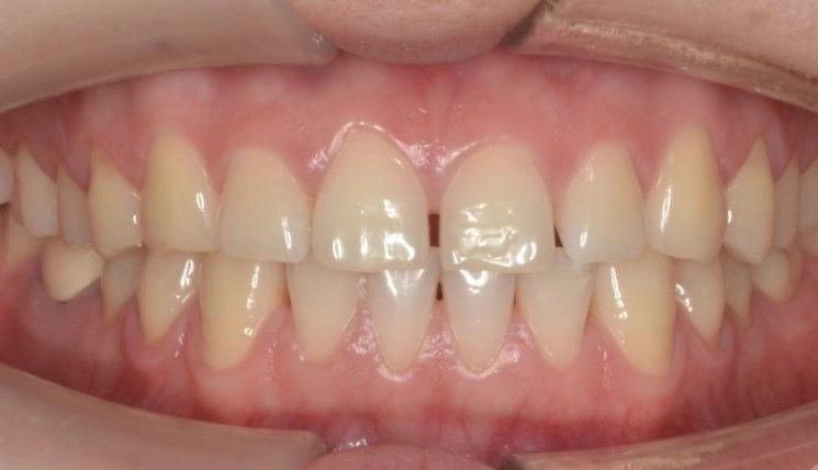 Spacing tooth case before Invisalign® treatment