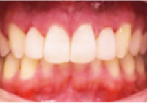 pre-restorative-2
