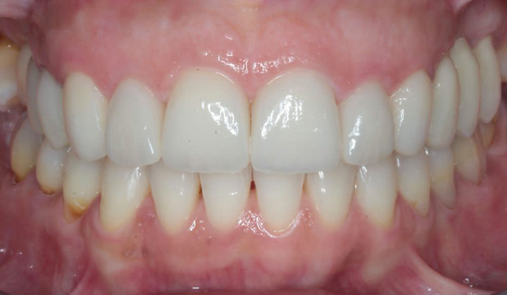 Generally straighter teeth case after Invisalign® treatment