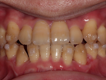 Anterior crossbite tooth case after Invisalign® treatment