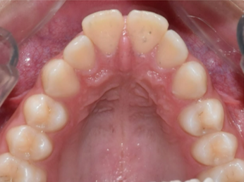 Narrow arches tooth case before Invisalign® treatment