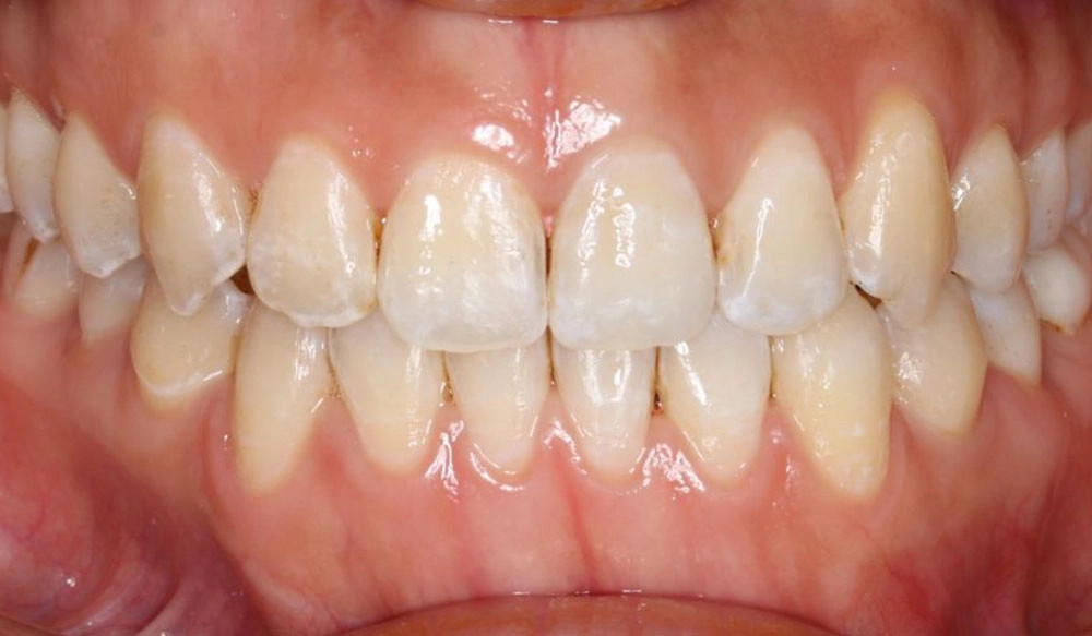 Posterior crossbite tooth case after Invisalign® treatment