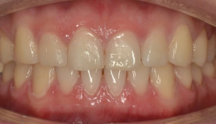 Spacing tooth case after Invisalign® treatment