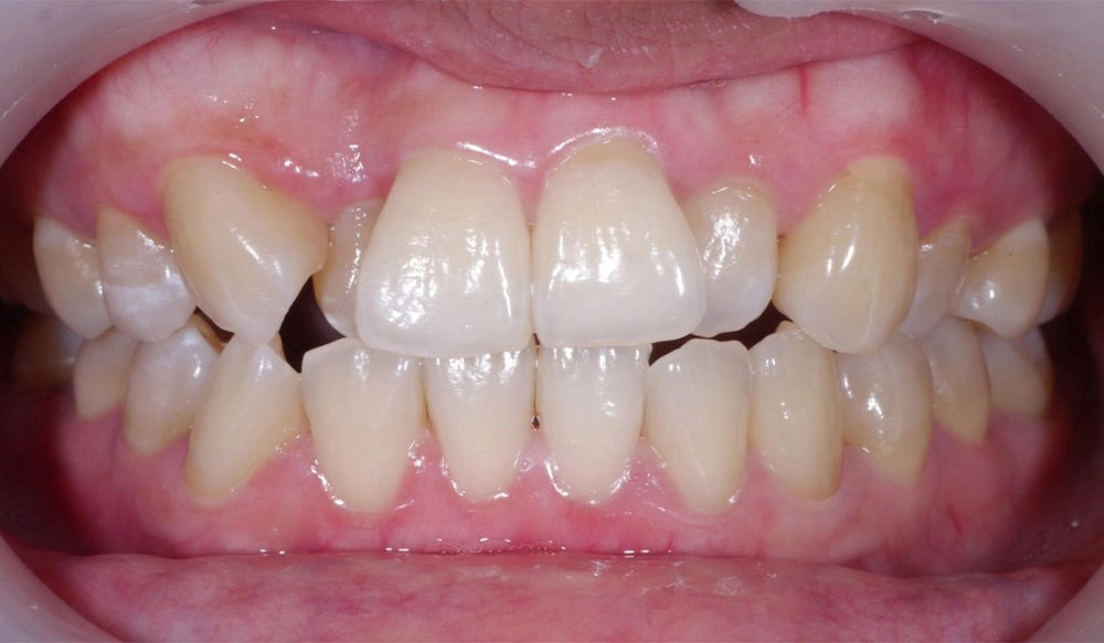 Class II tooth case before Invisalign® treatment