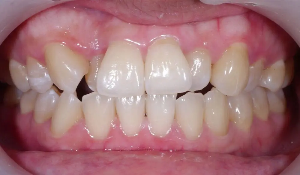 before image