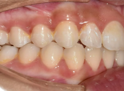 Mandibular advancement case after Invisalign® treatment