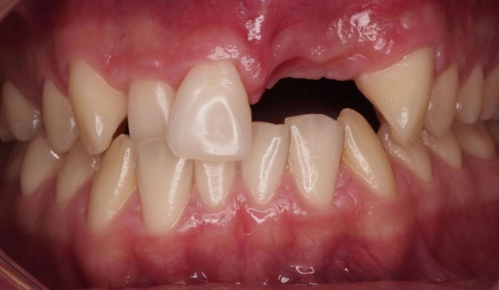 Surgical treatment tooth case before Invisalign® treatment
