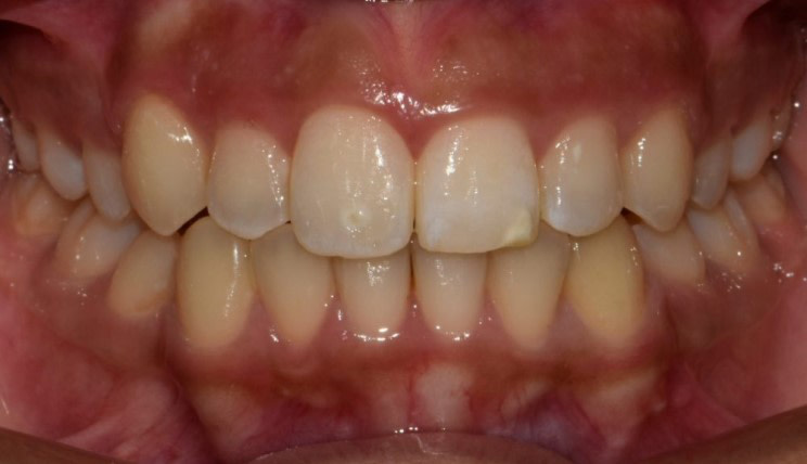 Crowding tooth case after Invisalign® treatment