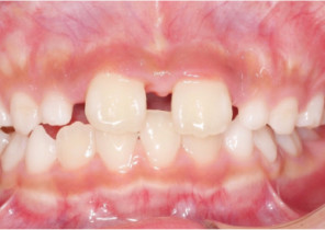 image-card-case1-post-invis-palatal-expander