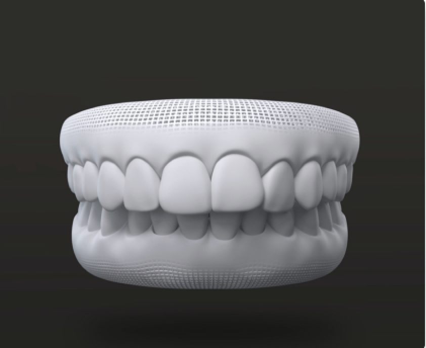 Casi trattabili: modello 3D morso profondo prima del trattamento Invisalign - Italia