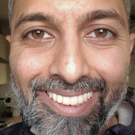 رجل يبتسم بعد نجاح علاج Invisalign®
