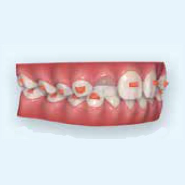photo-card-invisalign-first-erupting-permanent-dentition-support