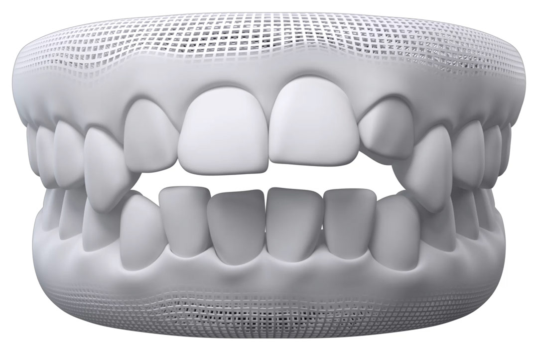 What are Invisalign Attachments? Why Are They Needed? - Dental Health  Society
