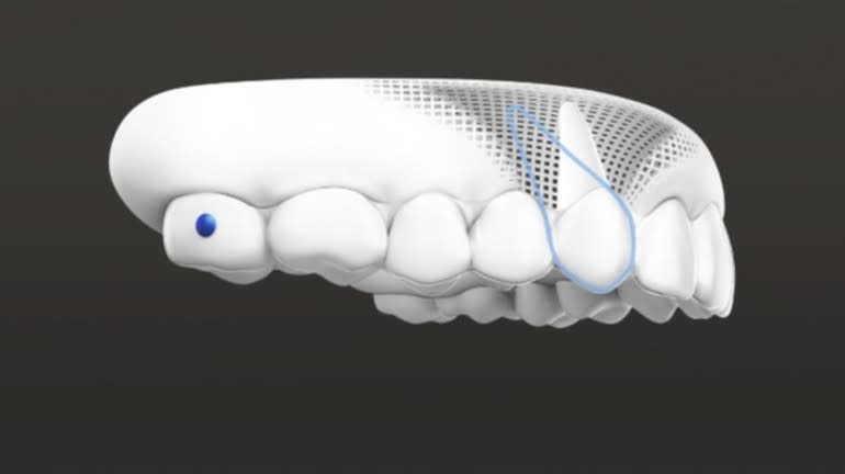Types of Invisalign patient - Adult > Carousel > Card #2 > Image