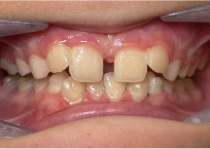 image-card-case2-post-palatal-expander