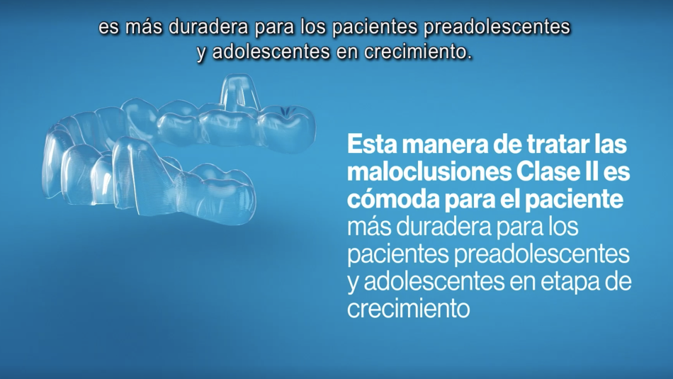 Avance mandibular(MA) para niños con Invisalign First (primera