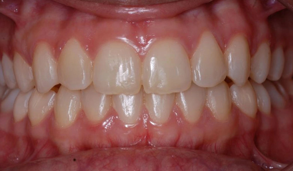 Narrow arches tooth case after Invisalign® treatment