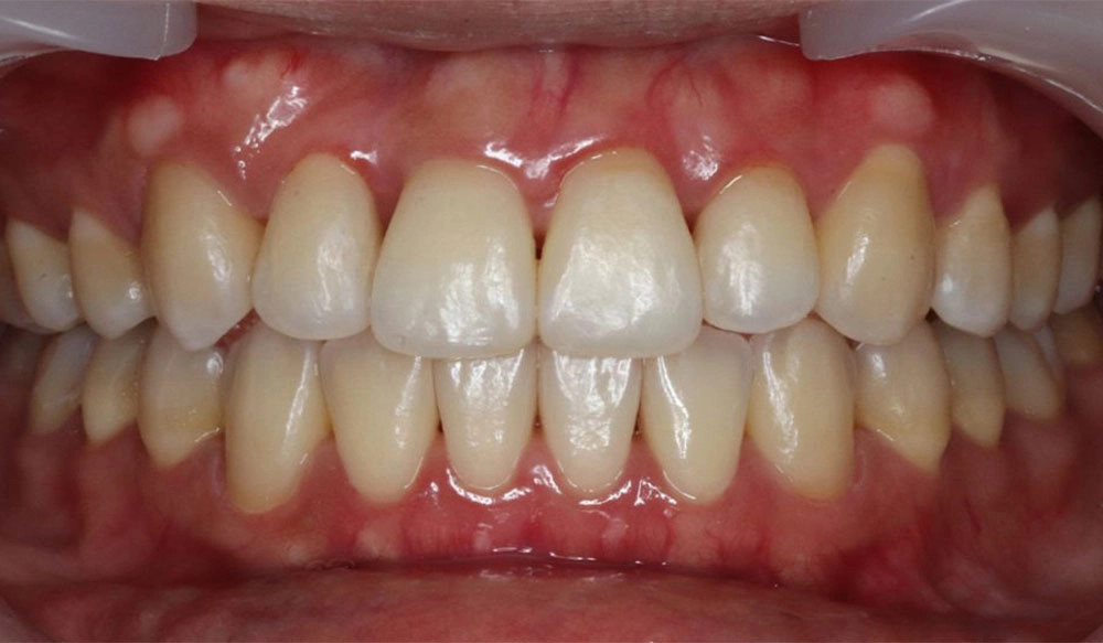 Class II tooth case after Invisalign® treatment