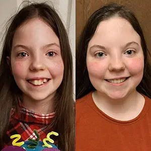 Little girl testimonial before and after treatment with transparent aligners