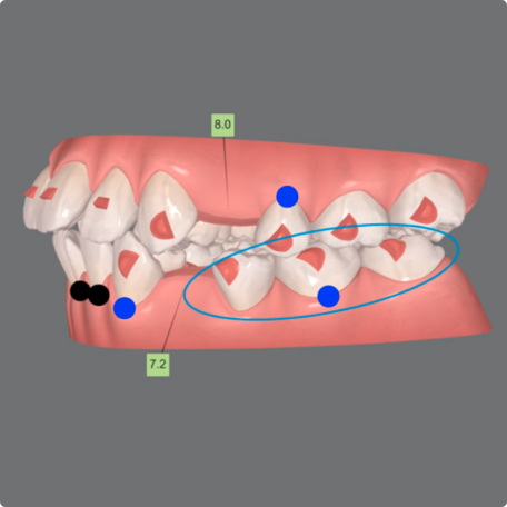 image-text-media-g6-solutions-1st-premolar-space-closure