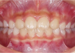 image-card-case1-pre-invis-palatal