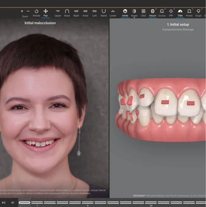  Invisalign® technology with 3D visual interface 
