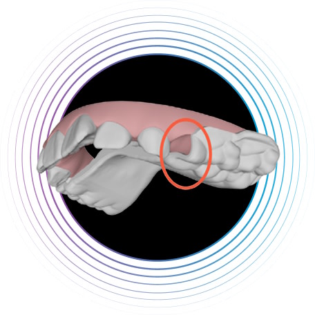 IPE-eruption-compensation-feature