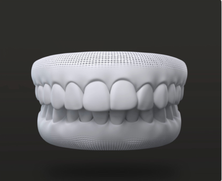 Invisalign Go > Overbite Aligner >Img-nw