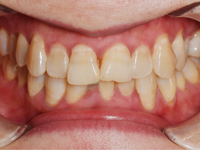 before image