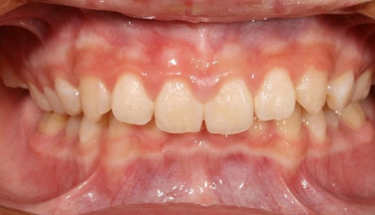 Mandibular advancement case before Invisalign® treatment