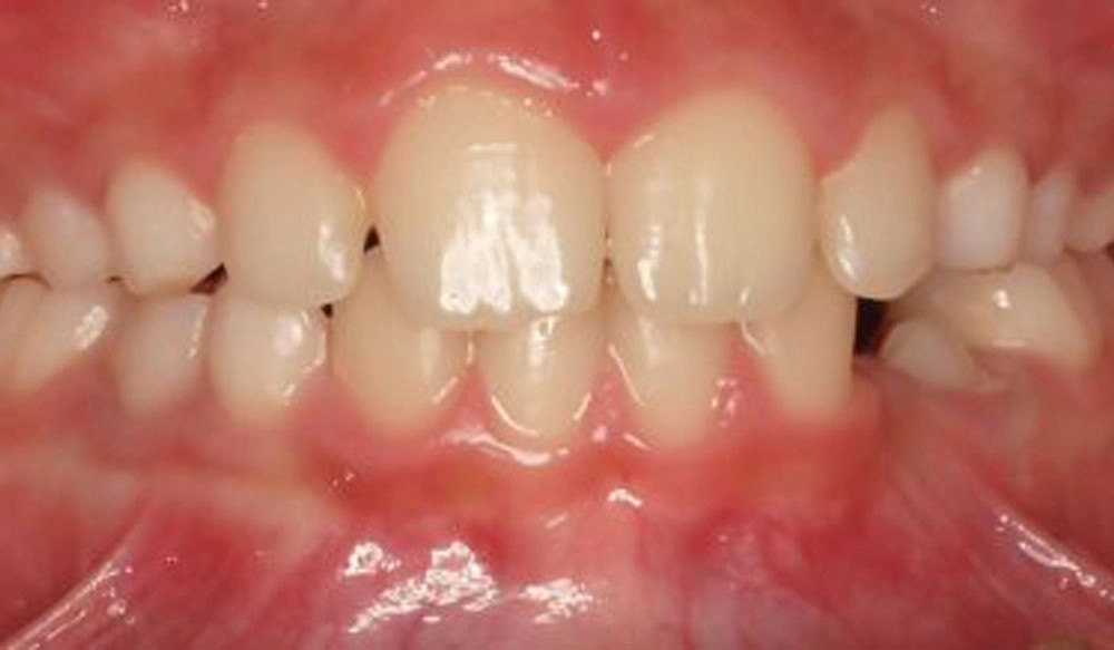 Phase I tooth treatment case after Invisalign® treatment