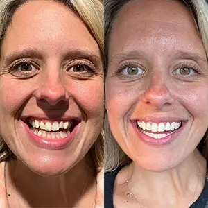 Woman testimonial before and after treatment with transparent aligners